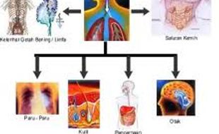 TUBERKULOSIS : 8.900 Pasien Indonesia Kebal Obat, Lalu?