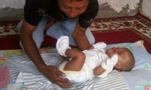 Kemenkes minta RS Sardjito segera tangani bayi tanpa mulut & hidung 