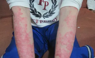 PSORIASIS: Perokok Berisiko Tinggi Psoriasis   