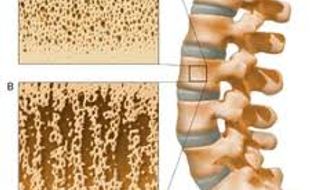 PENYAKIT TULANG: Waspadai Osteoporosis Karena Faktor Sekunder