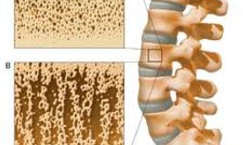 PENYAKIT TULANG: Waspadai Osteoporosis Karena Faktor Sekunder