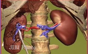 PERDAGANGAN ORGAN : Di Luar Negeri, Ginjal Bisa Laku Rp3 Miliar