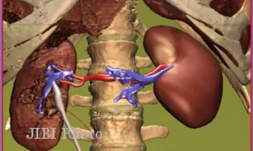 PERDAGANGAN ORGAN : Begini Modus Kejahatan Jual Beli Organ Manusia