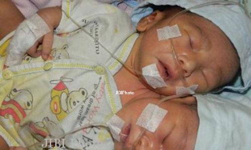 BAYI BERKEPALA DUA : Kondisi Pasien Kembar Kepala Bisa Memburuk