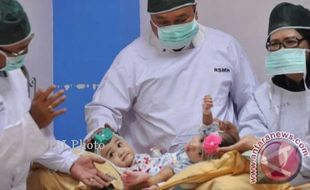 BAYI KEMBAR SIAM : Operasi Pemisahan Berhasil, Rahma-Rahmi Membaik