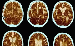 Hati-hati! Galau Akut Bikin Alzheimer