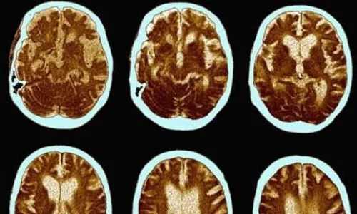 Hati-hati! Galau Akut Bikin Alzheimer