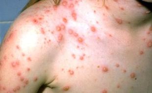 INFO MEDIS : Waspada! Herpes Zoster Bisa Rusak Saraf!