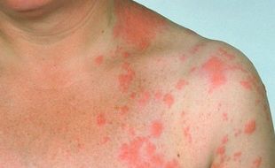 INFO MEDIS : Jaga Daya Tahan Tubuh Cegah Herpes Zoster