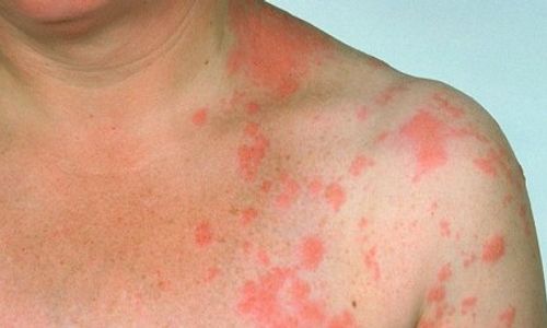 INFO MEDIS : Jaga Daya Tahan Tubuh Cegah Herpes Zoster