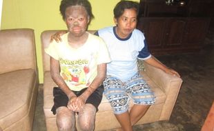 KISAH INSPIRATIF : Ichthyosis Lamellar Tak Bikin Yana Minder