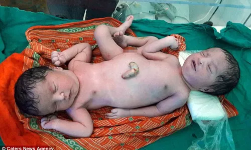 KISAH UNIK : Bayi Kembar Dampit India Berbagi Seluruh Organ Tubuh