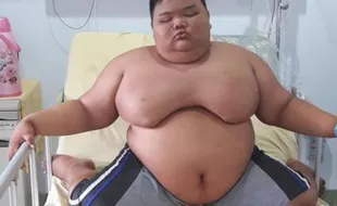 Bocah Obesitas Asal Palembang Koma