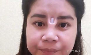 KISAH TRAGIS : Operasi Hidung Murahan, Wanita Ini Alami Hal Mengerikan