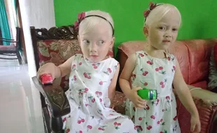 Masuk Kategori Albino Tingkat Tinggi, Anak Kembar Wonogiri Punya Kulit Putih Tanpa Bintik