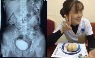 Batu Kandung Kemih Sebesar 10 Cm Dikeluarkan dari Wanita Ini