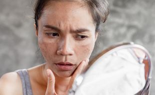 Mengenal Melasma, Kelainan Kulit yang Sering Diidap Perempuan