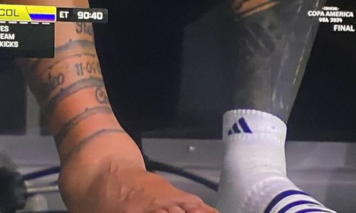 Bengkak, Ini Penampakan Kaki Messi Seusai Argentina Menangi Copa America 2024