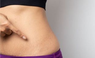 Cara Mencegah dan Mengatasi Stretch Mark, Termasuk Memakai Pelembab